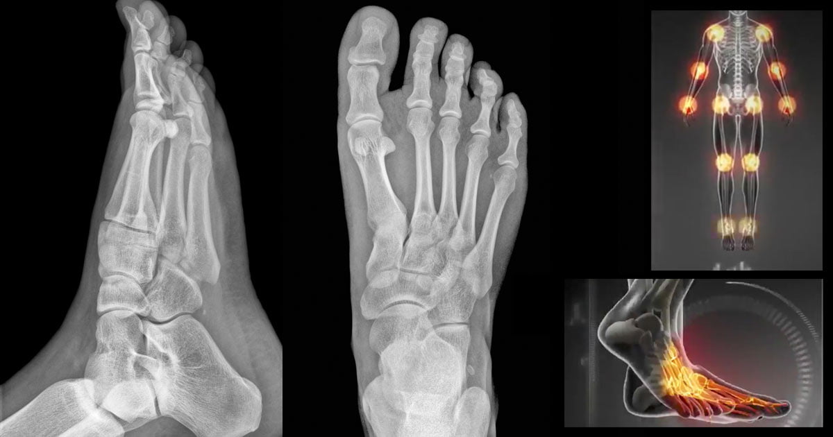 Two X-ray images of a right foot, from top and side, with a hot spot diagram to the right.